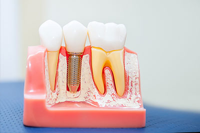 Alan S. Kuznick, DMD | CEREC, Veneers and Night Guards