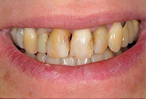 Alan S. Kuznick, DMD | Veneers, Dentures and Crowns